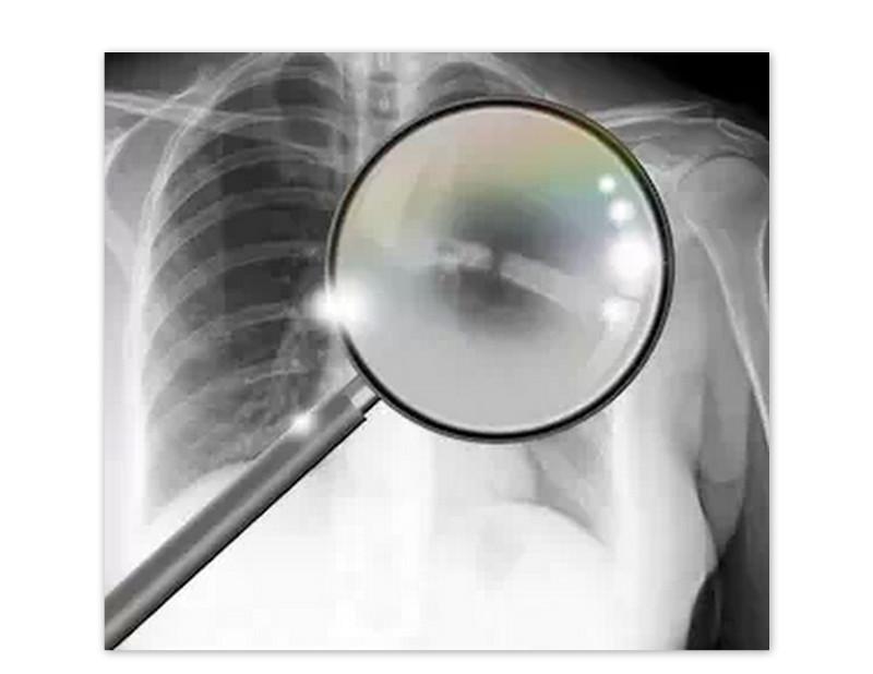 Steve's Broken Ribs